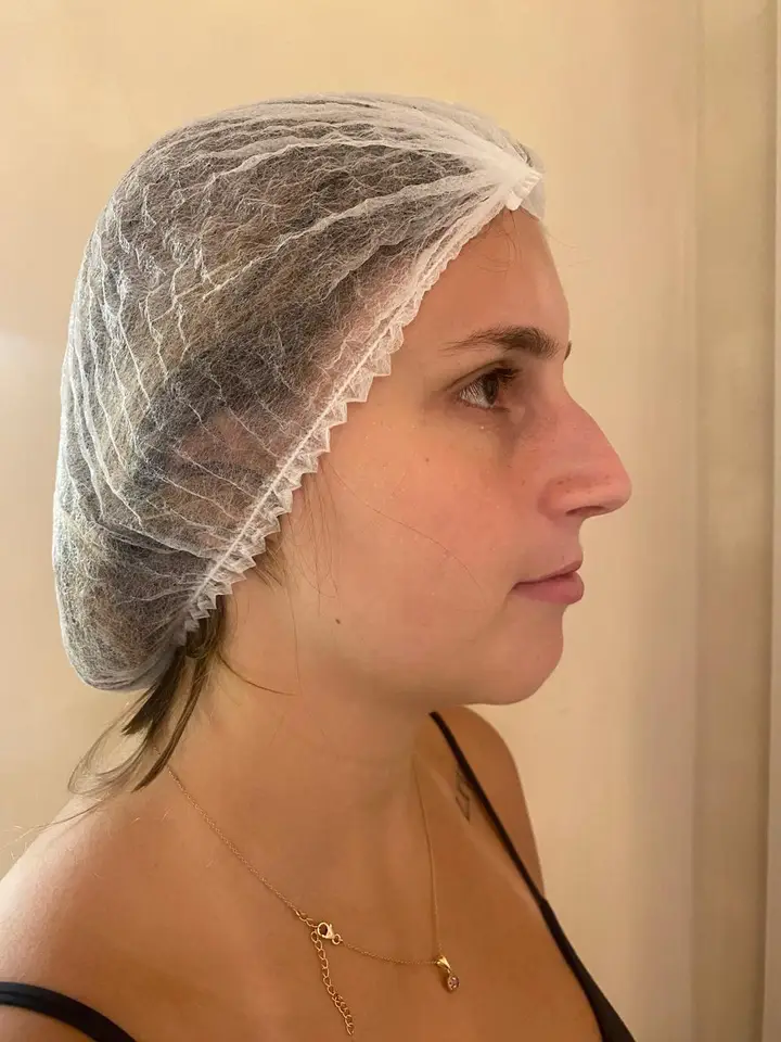 Antes, Harmonização Facial