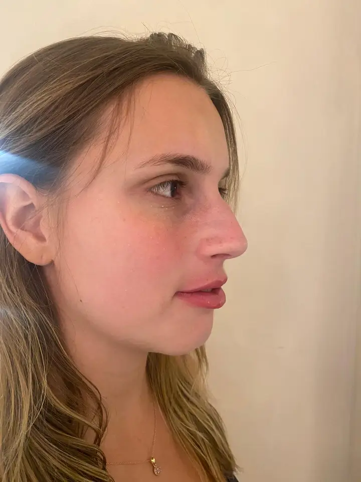Depois, Harmonização Facial