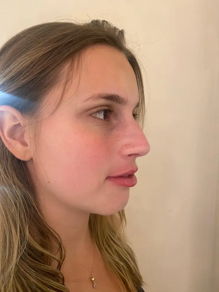 Resultado natural de tratamento facial na Vívera Estética, Ipanema